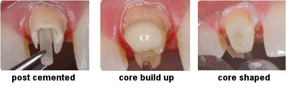 post and core